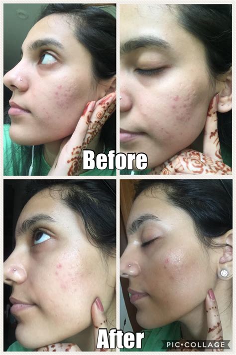 dermarolling before after collagen.
